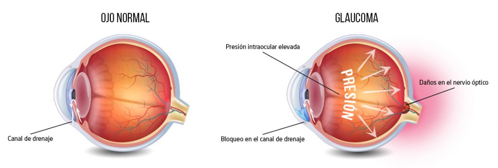 Transplant de cornee și glaucom