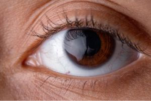Síntomas del desprendimiento de retina