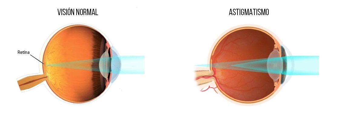 astigmatismo esquema