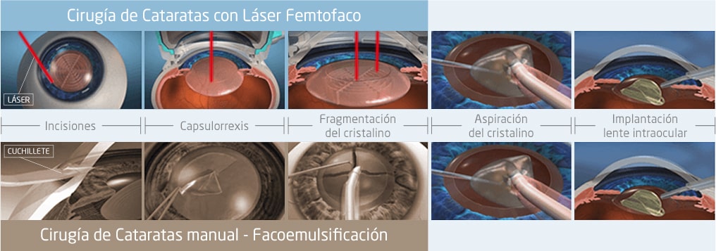 comparativa cirugia cataratas laser manual