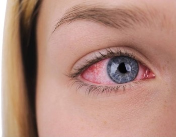 Venas del ojo inflamadas