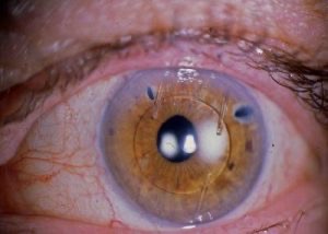 Extremo Refrescante Imperio Tengo lente intraocular y veo borroso【 causas, síntomas y tratamiento 】