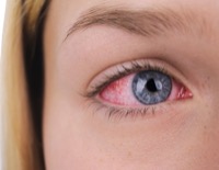 suero fisiológico ojos conjuntivitis