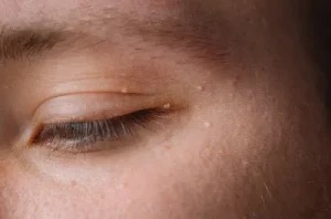 Verrugas: Qué hacer si aparecen en el cuerpo