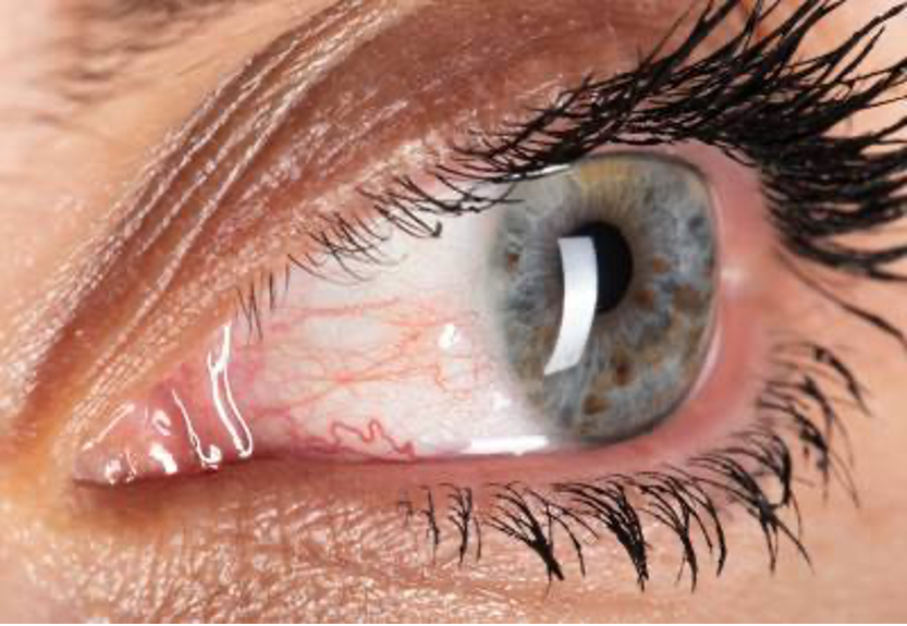 Rosácea ocular síntomas