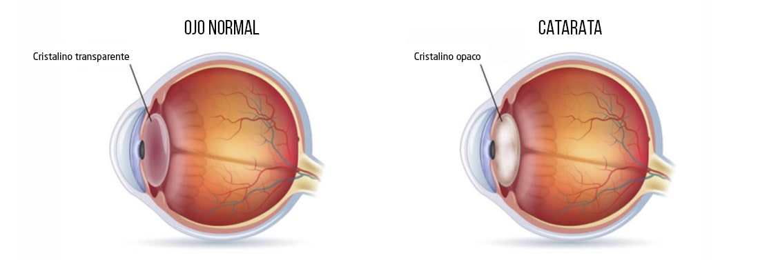 vision-con-cataratas-vs-vision-ojo-normal