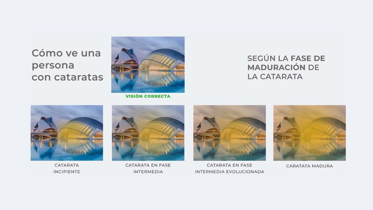 vision-catarata-incipiente-y-madura