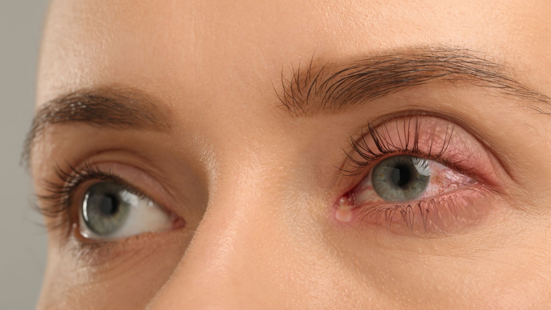 blefaritis-mas-frecuentes-sintomas-y-causas