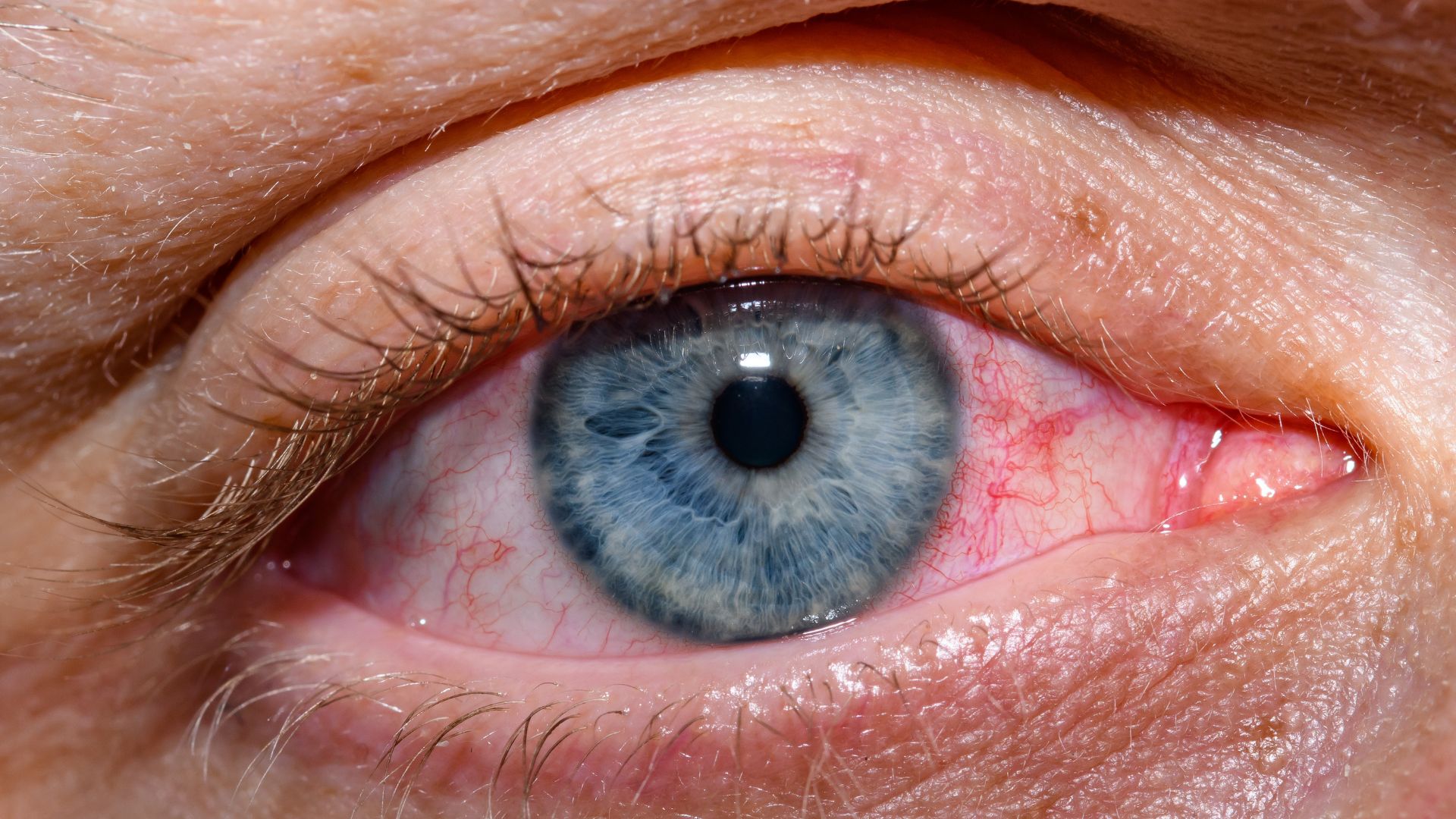 
conjuntivitis-problemas-oculares-frecuentes