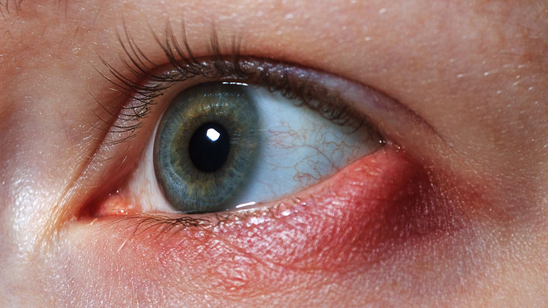 orzuelo-problemas-oculares-frecuentes