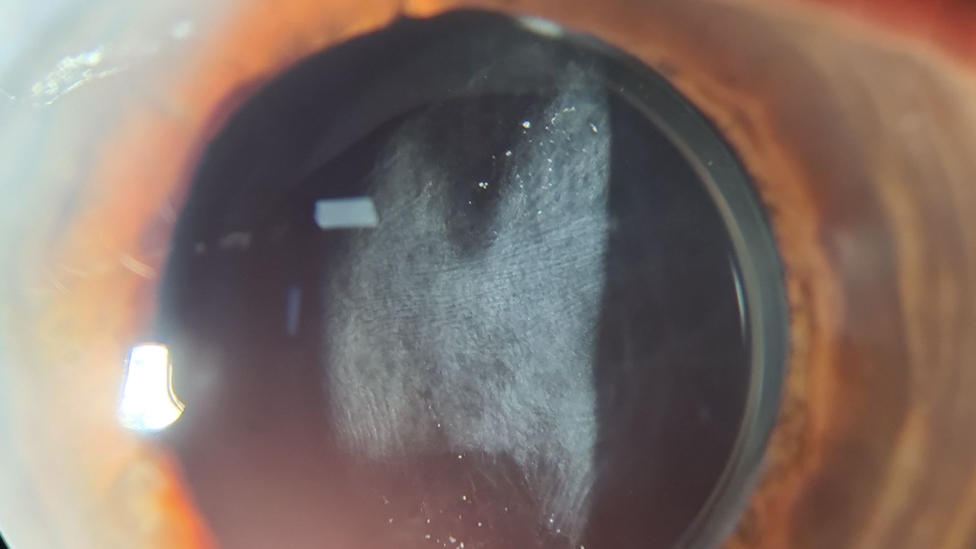 Opacificacion Capsular Posterior Vision Borrosa Cirugia Cataratas