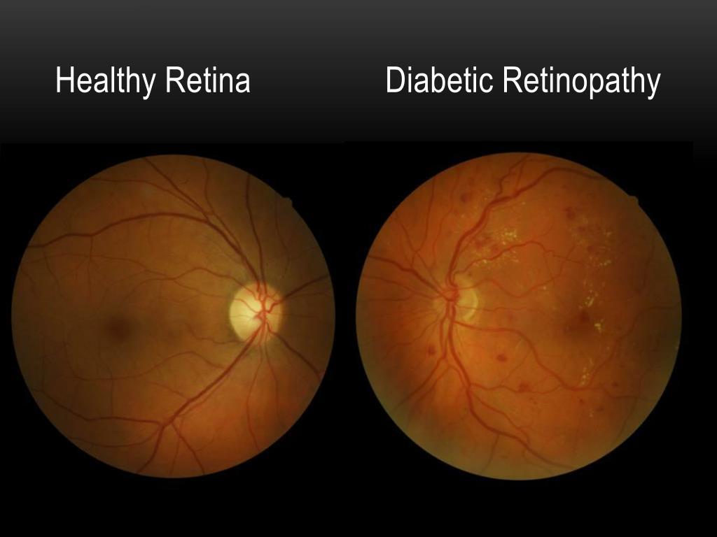 diabetes-y-revisiones-oftalmologicas